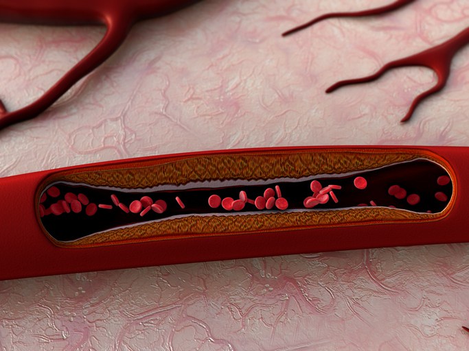 3D illustration of blood vessels, artery shown with a cut out section, a blood clot in the vessels, fat cell in the blood, inside the blood vessel, High quality 3d render of blood cells